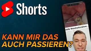 Schiefe Weisheitszähne shorts [upl. by Sada94]