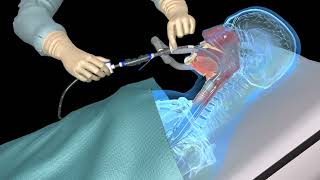 Suctioning the endotracheal tube  medical animation [upl. by Stavros]