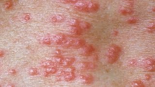 ❤Images Of Scabies How To Kill Scabies In House Do I Have Scabies How Do You Treat Scabies [upl. by Ennyletak]