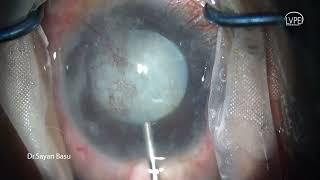 Phaco Xtreme Complex Cataract Surgery Case 2 [upl. by Nissy]