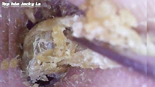 Ear Wax Removal  207 The earwax was so big that he couldnt hear clearly  Ear Cleaning ASMR [upl. by Narf917]