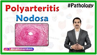 Polyarteritis nodosa  Definition Epidemiology Pathology Clinical features Diagnosis Treatment [upl. by Joses]