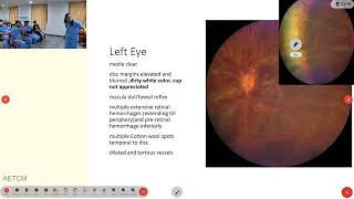 Ophthalmology Case Presentation [upl. by Enneiviv]