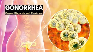 Gonorrhea Explained Symptoms Causes and Treatment Options [upl. by Atteirneh]