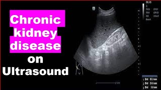 Chronic kidney disease on Ultrasound [upl. by Adaurd]