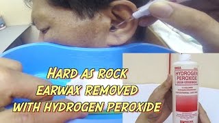 Hard as Rock Earwax Removal using Hydrogen Peroxide [upl. by Pillsbury]