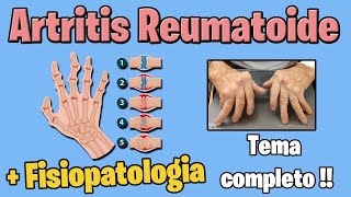 ARTRITIS REUMATOIDE  sintomas tratamiento  FISIOPATOLOGIA [upl. by Nerhe925]