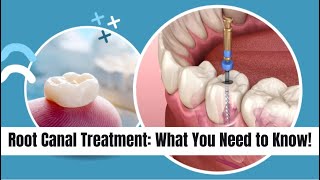 Root Canal Treatment What You Need to Know  Mind Musings dentistry dentalfacts rootcanal [upl. by Curren]