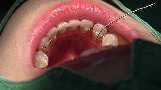 Bonded lingual fixed retainer in 10 min [upl. by Anil]