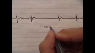 ECG simplified  Sinoatrial block [upl. by Linnet449]