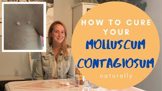 Molluscum Contagiosum How to cure it Naturally with Apple Cider Vinegar [upl. by Yeldarb]