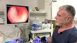 Endoscopia  Queixa de Dor Abdominal Azia e Vômito [upl. by Kera]