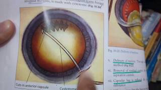 EXTRACAPSULAR CATARACT EXTRACTION Part 3 CONVENTIONAL METHOD made so easy [upl. by Lrig335]