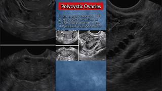 Polycystic Ovaries PCOs 💯❤️ polycysticovarysyndrome ovary pregnancy medical ultrasound health [upl. by Greer]