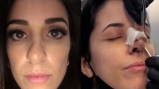 MY NOSE JOB REVEAL amp 2 WEEKS POST OP  Revision Rhinoplasty Experience in Turkey  Dr Umit Taskin [upl. by Belier642]