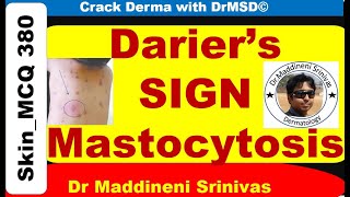 DARIERS SIGN  Mastocytosis  Urticaria Pigmentosa  Wheal  Histamine  Dermographism  DrMSD [upl. by Gaves]