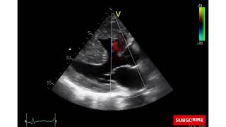 Tetralogy of Fallot  TOF Echo [upl. by Lehet]