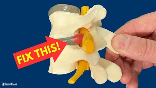 How to Relieve Herniated Disc Pain in SECONDS [upl. by Nalyt]