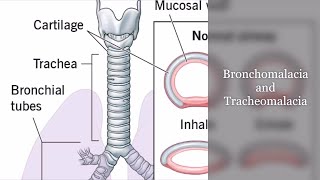 Bronchomalacia and Tracheomalacia [upl. by Arretak]