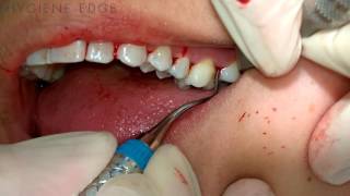 Gracey Instrumentation During Periodontal Therapy [upl. by Derinna]