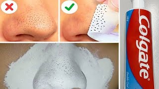 How To Remove BLACKHEADS at Home  In Just 5 Mints Best Way to Remove BLACKHEADS With Toothpaste [upl. by Bernadina]