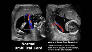 Umbilical Cord Ultrasound Normal Vs Abnormal Image Appearances Comparison  Fetal USG  Obstetric [upl. by Anail]