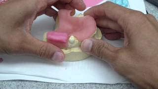 Immediate DentureRPD Jaw Relationship Record Fabrication [upl. by Randal]