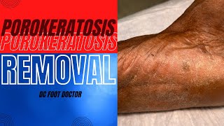 Porokeratosis Removal [upl. by Wolford]