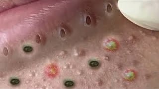 Big Cystic Acne Blackheads Extraction Blackheads amp Milia Whiteheads Removal Pimple Popping  329 [upl. by Wahl]