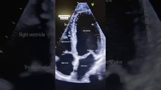 Heart Echocardiogram 🫀echocardiography ultrasound shorts heart [upl. by Gerlac]