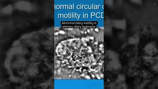 Abnormal ciliary motility in primary ciliary dyskinesia primaryciliarydyskinesia PCD [upl. by Accire]