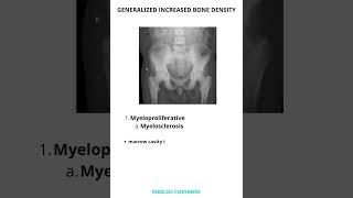 GENERALIZED INCREASED BONE DENSITY  Differential diagnoses [upl. by Ettelrahc917]