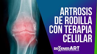 Cómo tratar la artrosis de rodilla con terapia celular [upl. by Akirahs]