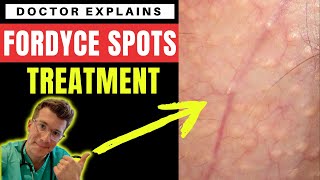 How to treat FORDYCE SPOTS  Doctor ODonovan explains [upl. by Ahsatak]