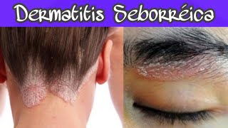 DERMATITIS SEBORRÉICA SÍNTOMAS Y TRATAMIENTO ¡PONLE FIN 😓 [upl. by Allisan615]