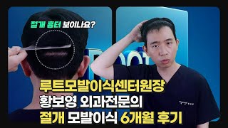 모발이식 후기 루트모발이식센터 황보영원장 모발이식 후 6개월 절개 흉터 [upl. by Natam]