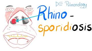 Rhinosporidiosis Rhinosporidium Seeberi [upl. by Howard]