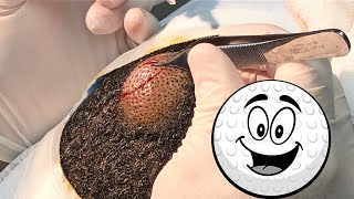 Giant Scalp Cyst Busted Simply Enormous [upl. by Dagna]