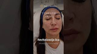 Lifting lica hijaluronskim filerima Forever young Medica Aesthetica skincare filler facelift [upl. by Radcliffe]