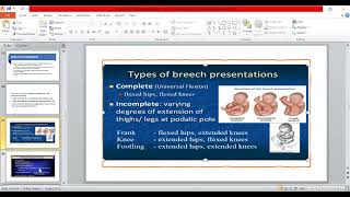 7B Malpositions amp Malpresentation part2  OBG [upl. by Valentia]