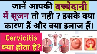 बच्चेदानी में सूजन क्यों होती है  क्या कारण और इलाज  Bacchedani mein Sujan  Cervicitis in hindi [upl. by Emmerie663]