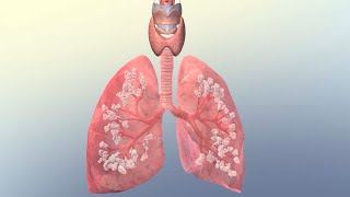 Common Causes of Respiratory Failure [upl. by Arahsat309]