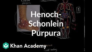 HenochSchonlein purpura  Circulatory System and Disease  NCLEXRN  Khan Academy [upl. by Norym260]