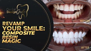 Revamp Your Smile Composite Resin Magic 🔥👌 [upl. by Mason]