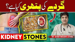 Is Your Lifestyle Causing Kidney Stones Find Out NOW [upl. by Nedle405]