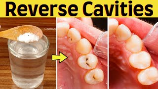 Get rid of cavities with baking soda and salt naturally in 2 days and stop from spreading [upl. by Westhead]