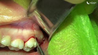 Exodontia de terceiro molar superior Upper wisdom tooth extraction [upl. by Myrtle]