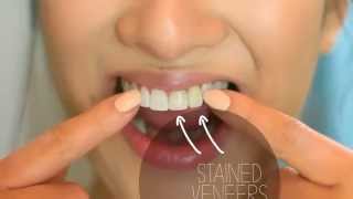 Braces and Teeth Whitening Johannesburg  Sandton and Bryanston Orthodontist [upl. by Mathre399]