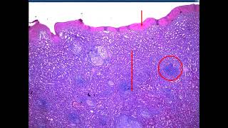 Sarcoidosis Rhino Actinomycosis Leprosy FB 2024  jars and slides [upl. by Eiboj]