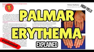 PALMAR ERYTHEMA Pathogenesis of Signs and Symptoms [upl. by Corbet]